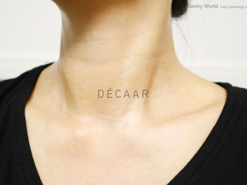 Peel da vùng cổ da sinh học ở tầng thượng bì